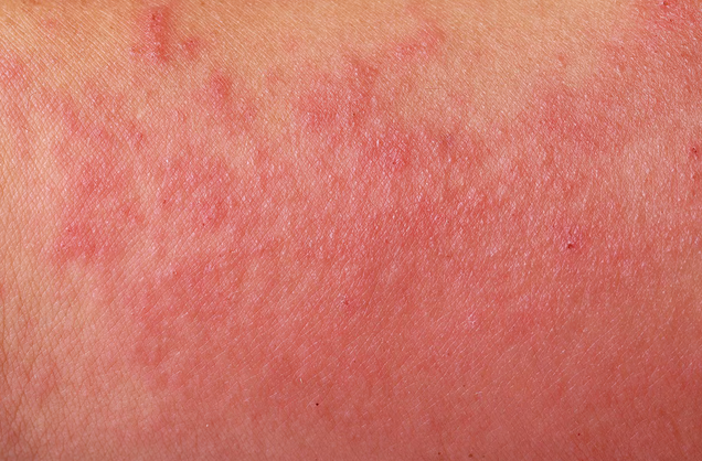 أعراض الطفح الجلدي والالتهابات الجلدية التي تستدعي الانتباه